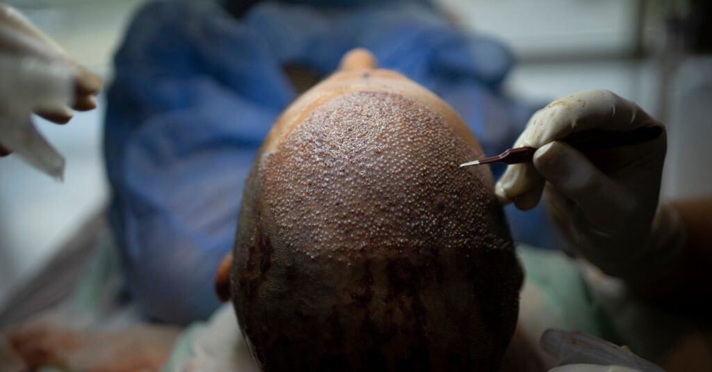 Turkey Built a Billion-Dollar Hair Transplant Machine Through Pure Tech Modern medical clinic interior in Istanbul representing Turkey's hair transplant industry